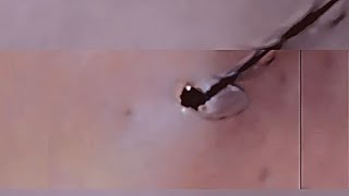 Removal of ingrown hair [upl. by Donia]