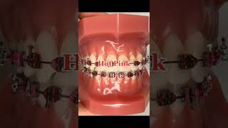 Braces Colors for Blonde Hair amp Green Eyes shorts tips braces bracescolors colors fyp hair [upl. by Marwin]