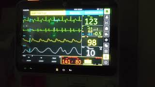 Ventricular Bigeminy [upl. by Borrell446]