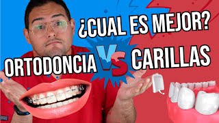 CARILLAS DENTALES VS ORTODONCIA ¿Se puede ALINEAR con CARILLAS ¿DISEÑO de SONRISA con BRACKETS 🔥 [upl. by Kirt694]