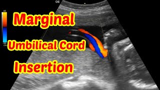 Marginal Umbilical Cord Insertion [upl. by Livvi]