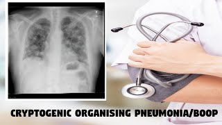 Cryptogenic organising Pneumonia  BOOP [upl. by Nwadahs]