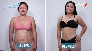 Abdominoplastía antes y después  Clínica Barrenechea [upl. by Llamaj]