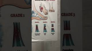 Grading of Ligament Tear youtube [upl. by Htebasile321]