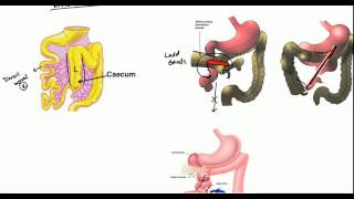 Gut Malrotation Nonrotation and Volvulus for USMLE [upl. by Ahsiyn]