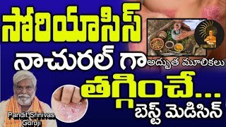 సోరియాసిస్ కు ఆయుర్వేదం లో అద్భుత మూలికలు ll మీ పండిట్ శ్రీనివాస్ గురూ ll [upl. by Ellicul]