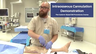 Intraosseous Cannulation Demonstration  The CadaverBased EM Procedures SelfStudy Course [upl. by Ahsyak220]