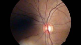 Optic Disc  Spontaneous Venous Pulsations [upl. by Nenad]