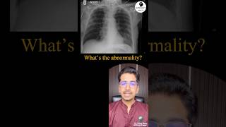 What’s the abnormality in Xray pulmonology radiology icu [upl. by Euqinommod]