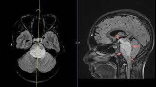 Diplopia vertigo and nystagmus in 34 year old [upl. by Selene415]