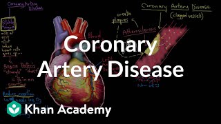 What is coronary artery disease  Circulatory System and Disease  NCLEXRN  Khan Academy [upl. by Lidstone483]