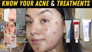 Pharmacy Creams to Treat Your Acne Right [upl. by Ferdinana]