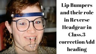 Lip Bumpers and their role in Reverse Headgear in Class3 correction [upl. by Danae]