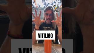 VITILIGO  Causas  Tratamiento Natural  Dr Ludwig Johnson short vitiligo ludwigjohnson [upl. by Rani]