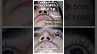 Face Nose Cheek Fat Grafting Asymmetry Correction in Delhi fatgraftingsurgery  nose  nosetip [upl. by Pang]