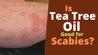 Tea Tree Oil for Scabies Does It Kill Scabies [upl. by Blumenthal]