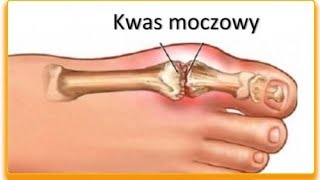 Owoce obniżające poziom kwasu moczowego we krwi [upl. by Neona]