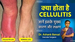 What is Cellulitis Understanding Causes Symptoms and Treatment Options with Dr Ashank Bansal [upl. by Rotsen63]