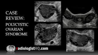 Ultrasound of Polycystic Ovarian Syndrome [upl. by Arehsat]