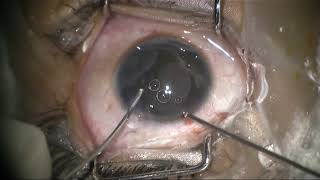 Triple treatment therapy for congenital stromal iris cyst [upl. by Ahseet693]