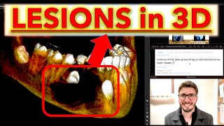 All Radiolucent Lesions with CBCT Periapical radiolucencies Cysts OKC Ameloblastoma lecture [upl. by Shishko]