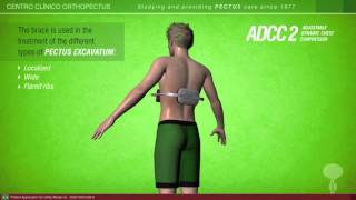 ADCC 1 and 2 braces for pectus carinatum and excavatum An Orthopectus invention [upl. by Woodruff]