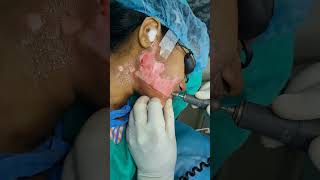 Best vitiligo melanocyte transplant under local anesthesia in RejuveDERMA clinic contact9700020802 [upl. by Crotty]