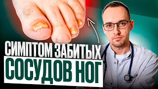 5 ПРИЗНАКОВ ЗАБИТЫХ СОСУДОВ НОГ Как проверить дома без врача [upl. by Yeldnarb562]