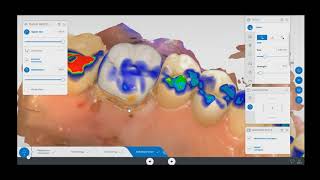 CEREC Crown Design Tooth 3 [upl. by Kyle]