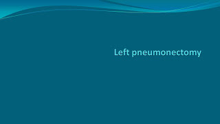 Left pneumonectomy  VATS and thoracotomy [upl. by Eachelle]