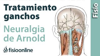 Tratamiento de fisioterapia con ganchos para la neuralgia de Arnold o neuralgia occipital [upl. by Adnalue841]