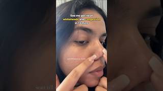 How to Remove blackheads whiteheads Blachheads skincare [upl. by Latouche867]