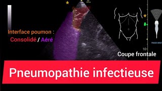 Pneumopathie Consolidation Échographie pulmonaire [upl. by Aurel]