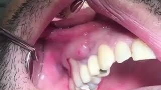 Popping a Tooth Abscess [upl. by Eecyak]