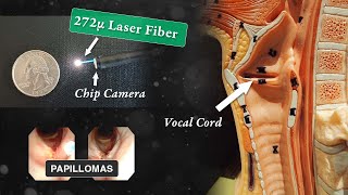 Laser Treatment of Laryngeal Papillomas RRP [upl. by Farrel]