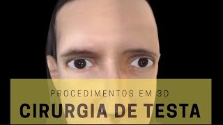 Procedimentos em 3D Cirurgia de Testa [upl. by Anes]