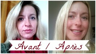 ACNE ❀ Roacutane mois après mois [upl. by Oric]