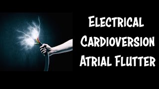 Emergency Cardioversion of Atrial Flutter [upl. by Antonietta]