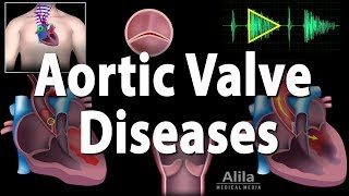 Aortic Valve Disease Animation [upl. by Esihcoc]