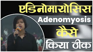 एडिनोमायोसिस Adenomyosis कैसे किया ठीक  Swami Ramdev [upl. by Erminna122]