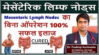 mesenteric lymph nodes ko kese thik kare  मिसेंट्रिक लिंफ नोड्स का इलाज without surgeryhomeopath [upl. by Ennovyhs]