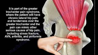 Gluteus Medius Tendon Tear  Everything You Need To Know  Dr Nabil Ebraheim [upl. by Earas]