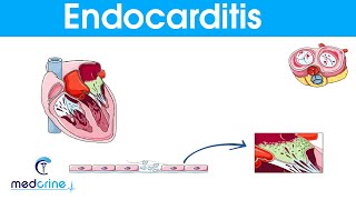 Endocarditis  causes symptoms pathophysiology diagnosis and treatment [upl. by Ik]