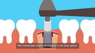 Een implantaat zetten bij de tandarts [upl. by Pennington]