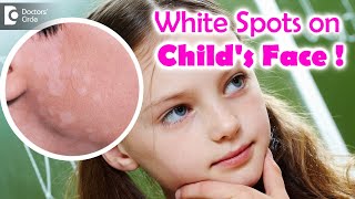 5 Things to know if your child is suffering from Pityriasis Alba  Dr Divya SharmaDoctors Circle [upl. by Lynnet]