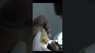 Planter wart removal laser treatment at hlccs ranchicall now 9334334935 wartsremoval warts [upl. by Onailil]