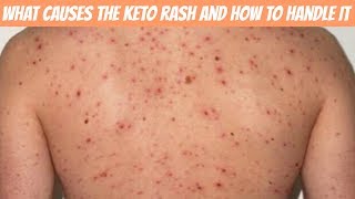 What exactly is a keto rash and how to handle [upl. by Yeliw]