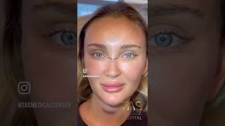 Scarless facelift and rhinoplasty by DrTAS drsuleymantas tasmedicalcenter scarlessfacelift [upl. by Arot495]