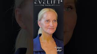 EVE Lift™ Patient Before and 4 Days After  Eden Plastic Surgery Dr Ali Charafeddine MD [upl. by Aihseken]