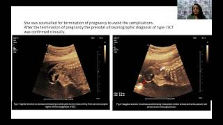 Shivani A Dabhade  PRENATAL ULTRASONOGRAPHIC DETECTION OF SACROCOCCYGEAL TERATOMA A CASE REPORT [upl. by Yllehs813]